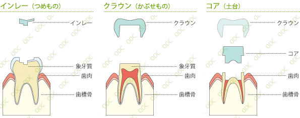 審美歯科の種類と適用部位